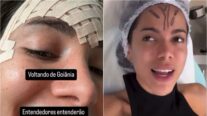 Anitta mostra curativo na testa e diz ter feito remoção de veia: ‘É só um laser, não é cirurgia’